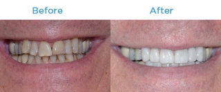Teeth Restorations