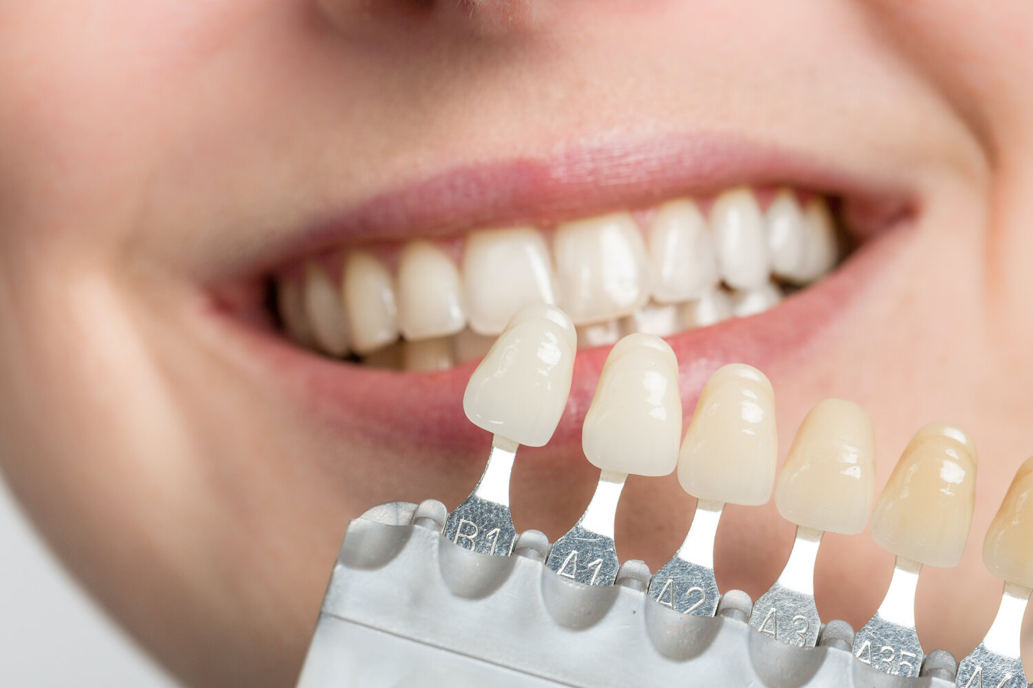 Dentistry. Dentist. Porcelain Veneers.