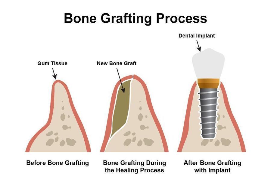 Bone Grafting Process.